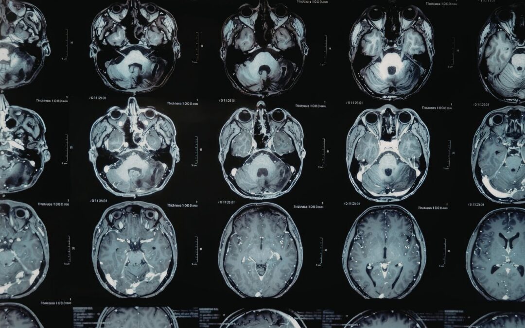 The Brain Affected by Addiction vs. the Healthy Brain: What the Science Reveals