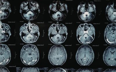 The Brain Affected by Addiction vs. the Healthy Brain: What the Science Reveals
